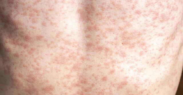 RFK Jr. Needs to ‘Unconditionally’ Advocate for Measles Vaccine, Lack of Vaccination Causing Deaths, Outbreak